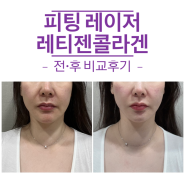 통증없는리프팅 피팅레이저 레티젠콜라겐 후기