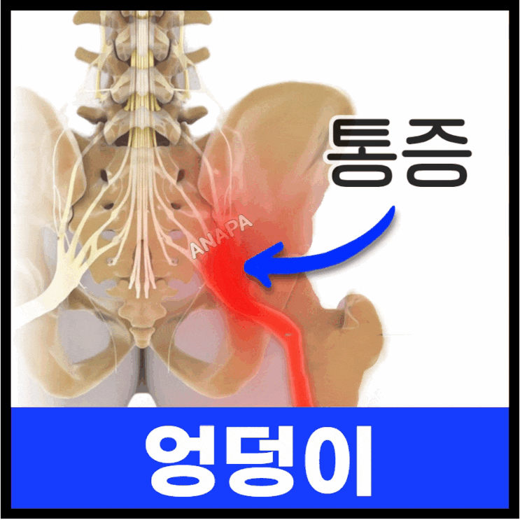 좌골신경통 원인 치료방법 - 허리 디스크? 다리저림 : 네이버 블로그