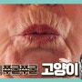 여의도 유스피부과 추천 입술위 인중( 고양이 , 치마 )주름의 원인과 치료법 3가지 보톡스 필러 트리필프로