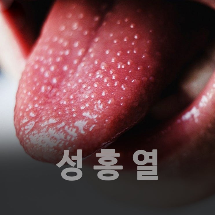 성홍열 딸기혀와 발진 원인 전염 격리 기간 : 네이버 블…