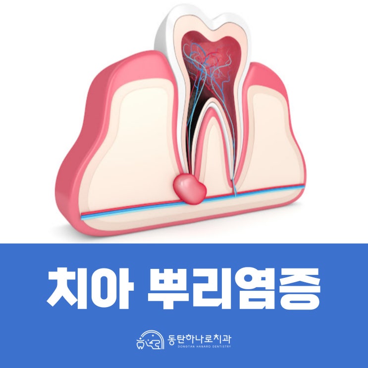 치아 뿌리 염증 원인과 치료 : 네이버 블로그