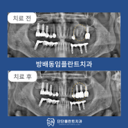 방배동임플란트치과 뿌리만 남은 어금니를 발치하고