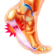 부산 서면 정형외과 족저근막염 치료 방법