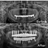 임플란트크라운빠짐 이럴 때 어떻게 해야 해야 할까?