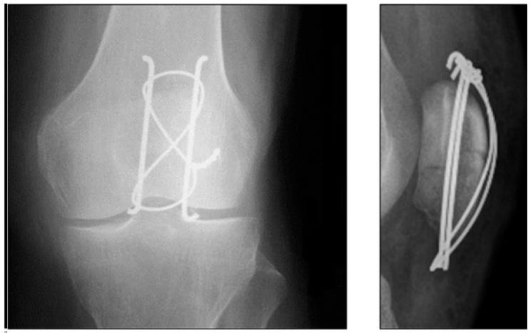 Patella Fracture 슬개골 골절 Tension band wire ️양산피티 GYM502 PT : 네이버 블로그