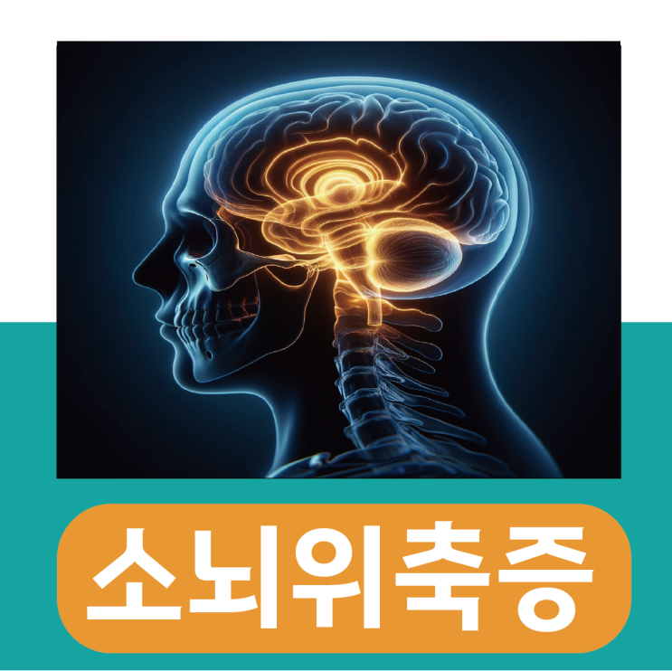 소뇌 위축증 원인 초기증상 검사 치료 방법 : 네이버 블로그