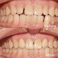 오남치과, 벌어진치아 부분교정으로 고르게 만든 후기
