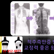 척추측만증 각도가 20~40도이면 척추측만증 보조기 치료를 해야 합니다- 원남메디칼(주) 원남보조기