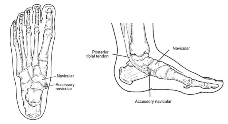 부주상골 증후군 [ Accessory navicular syndrome ] : 네이버 블로그