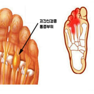 발가락 지간신경종 치료법 (경험담)