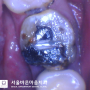 흔들리는 치아가 있으신가요? 금천구청역 치과 에서 무통마취로 신경치료 통증 없이 해결합니다.