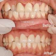 오남리치과, 앞니 통증 및 잇몸 붓기 임플란트 하지 않아도 될까?