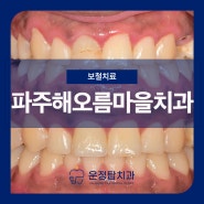 파주해오름마을치과 예전에 치료한 레진이 변색되고 금이갔어요