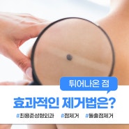 대구튀어나온점 깔끔하게 제거하는 방법은