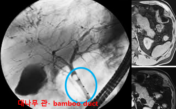 Case_Study_534_지방변으로 체중이 감소되어 내원한 60세 남자_자가면역성 췌장염(Autoimmune ...