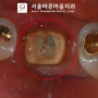 "먹다가 뭐가 빠졌어요" 시흥동 치과 에서 탈락한 크라운 치료 다시 해드렸어요.