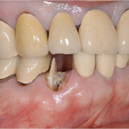 치아 빼고 임플란트를 해야할까요? 뿌리까지 썩은 치아 살려쓰기