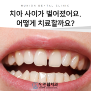 치아사이가 벌어졌어요. 어떻게 치료할까요?