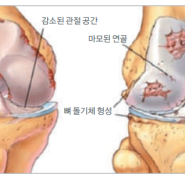 퇴행성관절염 미리미리 예방해요~