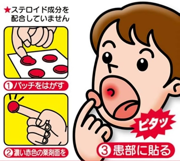 입병 자주 나는 사람들 안보면 평생후회! /구내염 안나는 법/일본 입병패치 사용법/ 구내염 빨리낫는법!/ 구내염 필수템 ...