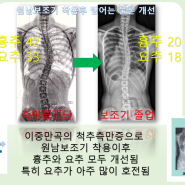 척추측만증 진단이후 척추측만증 보조기 졸업을 하기 까지~:원남메디칼(주) 원남보조기