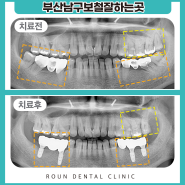 부산남구보철잘하는곳, 오래된 브릿지는 어떻게 하나요?