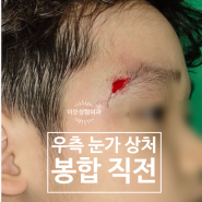 어린이 얼굴 봉합 후기 (상처 성형외과)[서울 김포 신촌 홍대 구로 신림 보라매 대학병원 응급실 마포 합정 이태원]