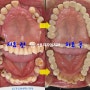 전체 잇몸 염증 으로 발치 후 수면 임플란트 수면마취 후 뼈이식술 임플란트 진행하신 40대 케이스 길동 치과