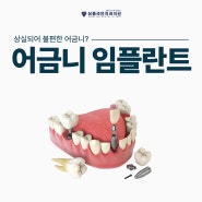 진주치과의 어금니 임플란트 잘 하는 곳을 찾는다면