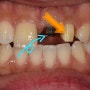 앞니 임플란트 수술 및 재신경치료 (임시치아, 뿌리 끝 염증, 농)
