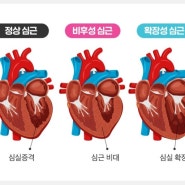 심장근육병증에 대해 알아보자