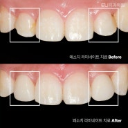 부산진구치과 라미네이트 가격 장단점 후기