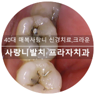 광교 수원 사랑니발치 40대 매복 사랑니발치 인접면 우식 신경치료 크라운 feat. 치아 파절 잔존치근 발치 덴티스 임플란트