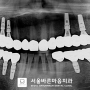 금천 치과 에서 65세 이상 보험 임플란트 상담 후 수술했습니다.