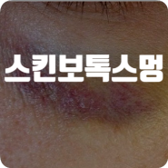 스킨보톡스멍 시술 효과 주름 내성 엠보 예방 주기