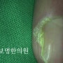 손 사마귀 제거가 반복하면 망합니다