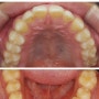대구부분교정 벌어진 앞니 라미네이트 대신 공간 메우기