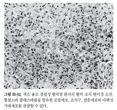 색소 융모 결절성 활액막염 (Pigmented Villonodular Synovitis, PVNS) : 네이버 블로그