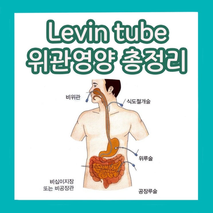[응급실 간호] Levin tube(L-tube), PEG tube 위관영양, 배액법 및 총정리 : 네이버 블로그