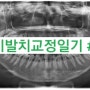 [서른살 비발치 치아교정일기/내돈내산]#5.