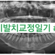 [서른살 비발치 치아교정일기/내돈내산]#5.