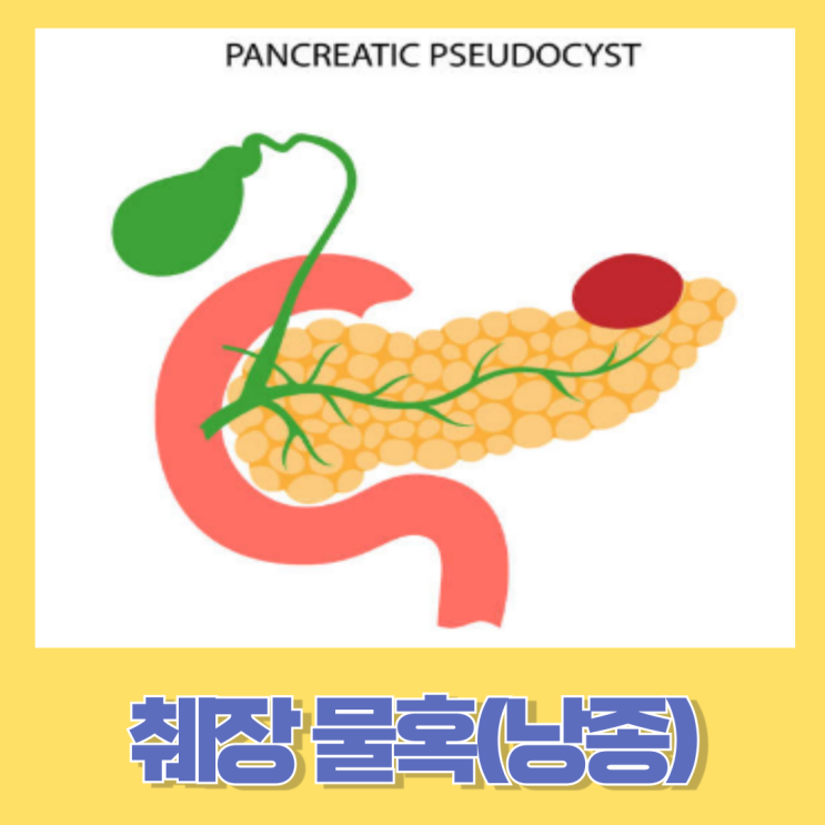 췌장 물혹(췌장 낭종)의 원인과 증상 그리고 치료법 : 네이버 블로그