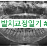 [서른살 비발치 치아교정일기/내돈내산]#6. 교정 4개월만의 기적, 비교샷