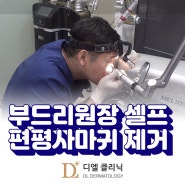 센텀 해운대 피부과 디엘의원 부드리원장 셀프 편평사마귀 제거