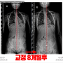 동탄 척추측만증병원 H드림 허리옆굽음 교정기 바른 착용 각도는?