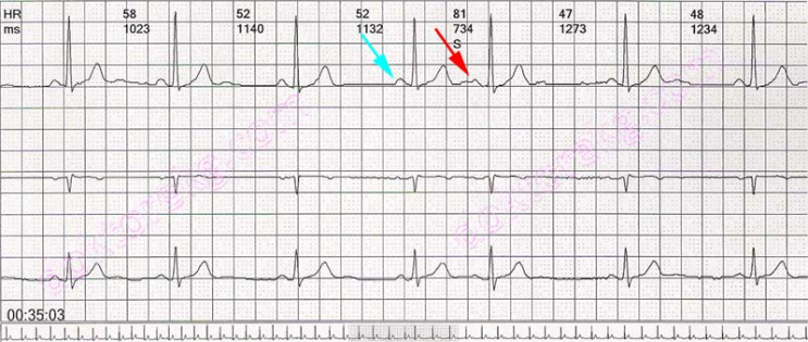 심방조기수축 : 의학용어 APC, PAC / atrial premature contraction EKG 리듬 / 심방조기박동 ...