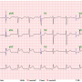 급성 흉통 환자의 심전도