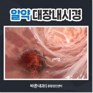 알약 대장내시경으로 좀 더 편한 내시경 받기