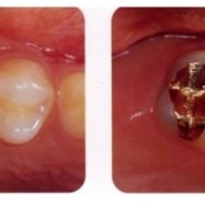 골드인레이,어금니충치,신월동충치!