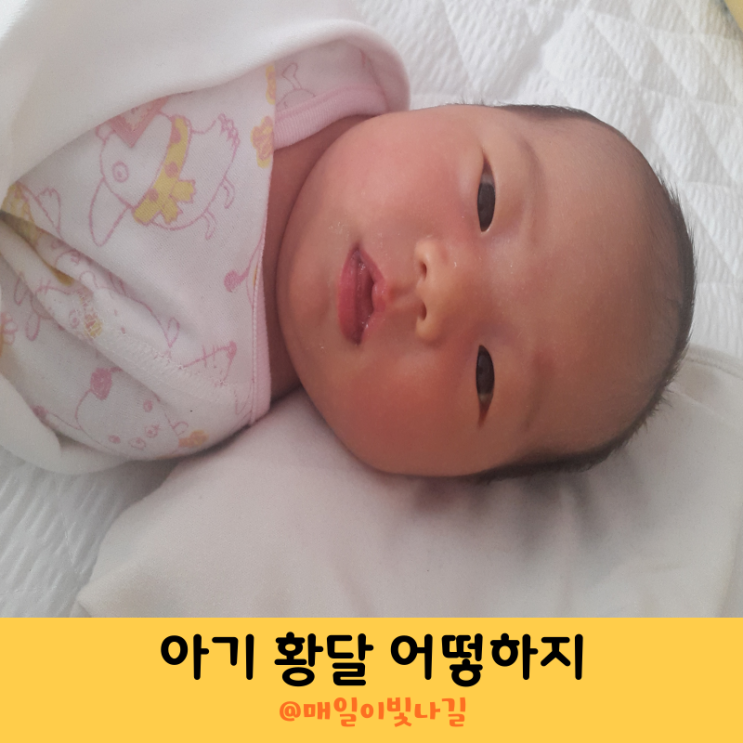신생아 황달수치 아기 모유황달 증상 치료 : 네이버 블로그